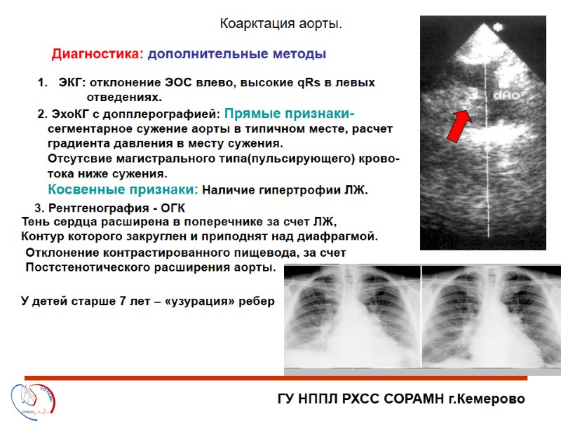 ГУ НППЛ РХСС СОРАМН г.Кемерово Коарктация аорты. Диагностика: дополнительные методы ЭКГ: отклонение ЭОС влево,